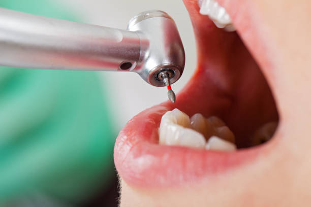 Best Dental Abscess Treatment in Silverton, OR